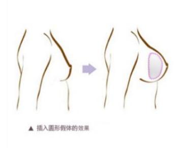 適合圓形假體的人群