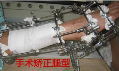 什么方法可以糾正X形腿?