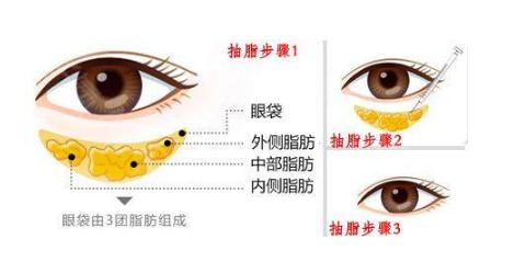 整理了調(diào)節(jié)眼袋的方法幾種方法 看你適合哪一種