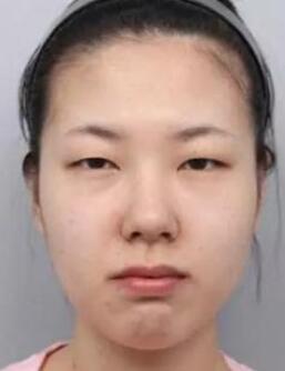 腫眼泡吸脂的果