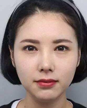 腫眼泡吸脂的果