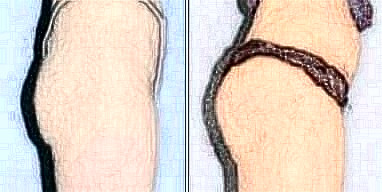 豐臀手術(shù)前的注意事項(xiàng)