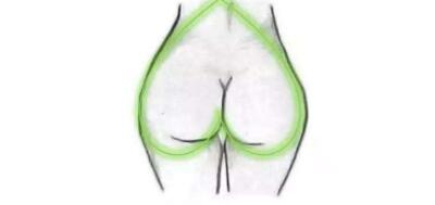 豐臀手術(shù)后注意事項(xiàng)