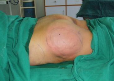 豐臀手術(shù)后注意事項(xiàng)