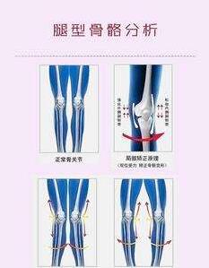什么方法可以糾正X形腿?