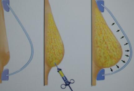 隆胸會(huì)影響母乳喂養(yǎng)嗎?