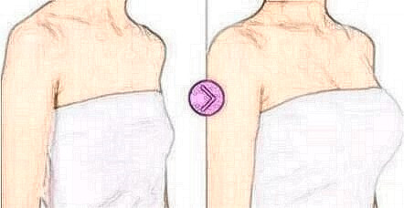 隆胸術(shù)后注意事項(xiàng)