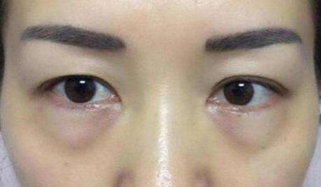 整理調(diào)節(jié)眼袋的方法幾種方法！看你適合哪一種？