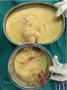 為什么玻尿酸填充臉頰多年不吸收?