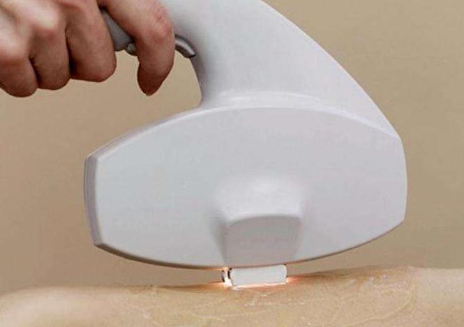 腋窩*脫毛多少錢？