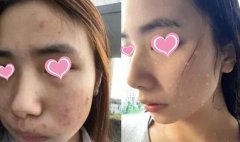 痘星人做像素激光去痘簡直太靠譜了，果圖