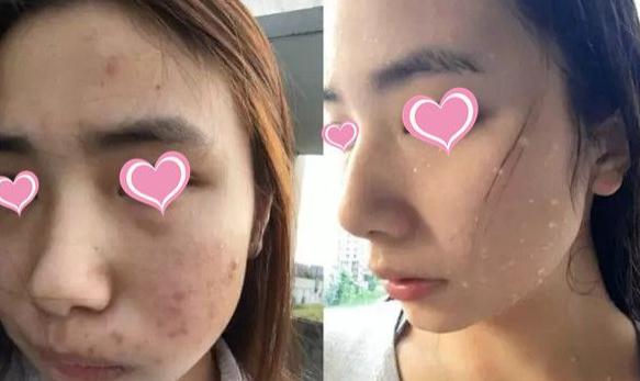 痘星人做像素激光去痘簡直太靠譜了，果圖