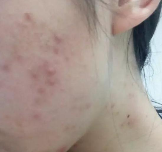 痘星人做像素激光去痘簡直太靠譜了，果圖