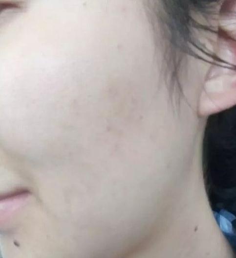 像素激光去痘術(shù)后果