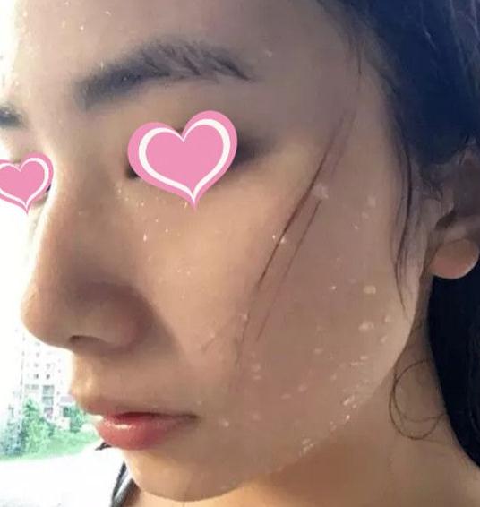 像素激光去痘術(shù)后果