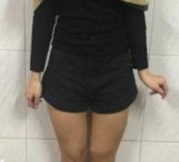 做完大腿部吸脂塑形手術(shù)后，p圖軟件都閑置了