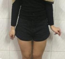 做完大腿部吸脂塑形手術(shù)后，p圖軟件都閑置了