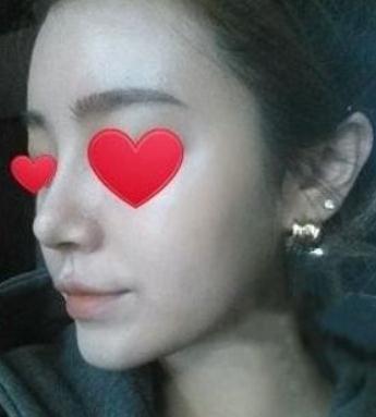 硅膠隆鼻要多少錢？