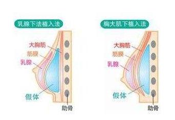 做完乳房假體植入手術(shù)之后的護(hù)理指導(dǎo)~