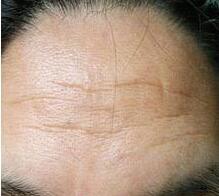 去除抬頭紋注意事項