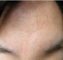 去除抬頭紋注意事項