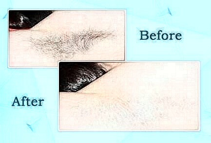 激光脫毛的優(yōu)勢