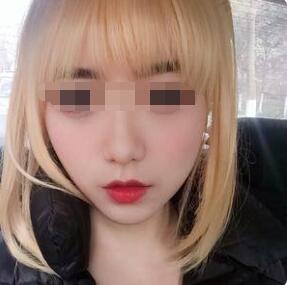 豐唇手術(shù)術(shù)后一個(gè)月