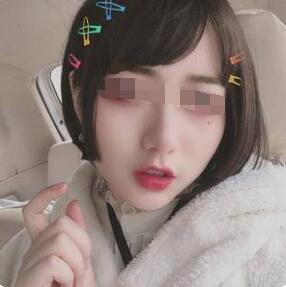 豐唇手術(shù)術(shù)后半個(gè)月