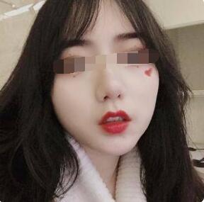 豐唇手術(shù)術(shù)后一個(gè)月