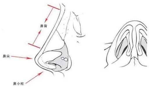 假體隆鼻手術(shù)的過(guò)程