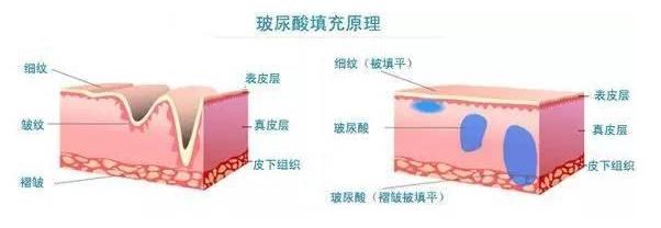 注射玻尿酸祛皺是否有風(fēng)險(xiǎn)呢？有哪些風(fēng)險(xiǎn)？