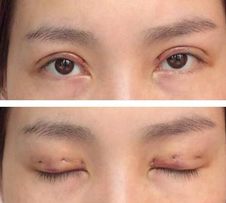 韓式三點式雙眼皮手術是什么?