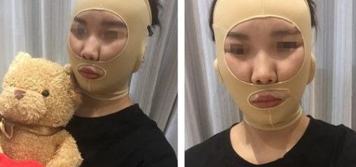 面部吸脂術(shù)后第4天