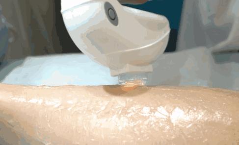 做冰點脫毛有風險嗎？有哪些副作用？