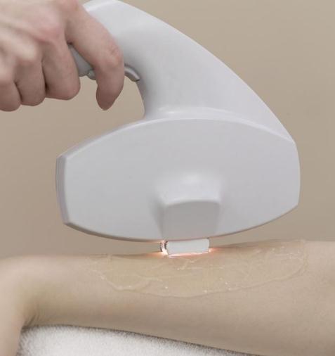 冰點脫毛副作用