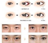 外眼角開大不滿意，可以怎樣修復(fù)呢？