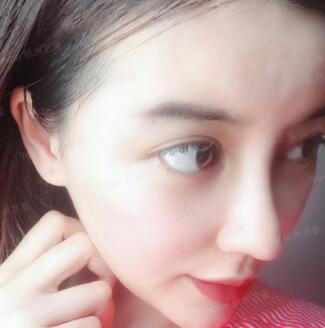 隆鼻手術(shù)注意事項(xiàng)