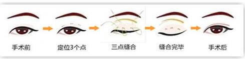 韓式三點式雙眼皮的優(yōu)點