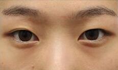 對(duì)于我們每個(gè)人來(lái)說(shuō)首先要明白有沒(méi)有必要開(kāi)外眼角?