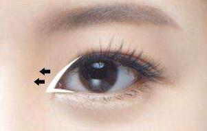 開眼角手術(shù)能給你帶來哪些果?不僅僅是放大雙眼