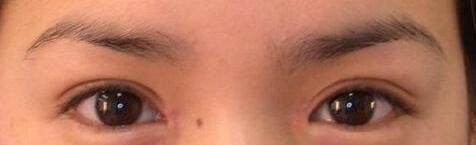 開眼角手術(shù)后的注意事項