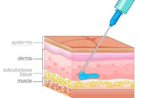 注射玻尿酸的注意事項