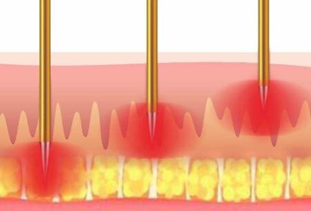 普通微針和黃金微針有哪些本質(zhì)上的區(qū)別?