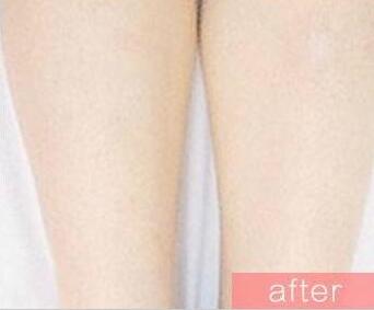 激光脫毛后的注意事項