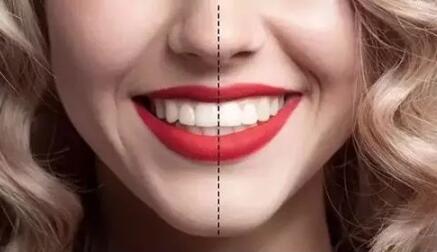 做冷光美白牙齒能解決煙民們的牙黃問題嗎？