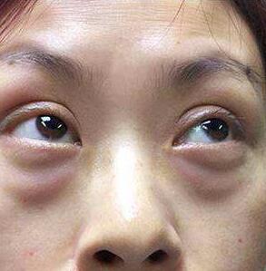 眼袋的祛除方法