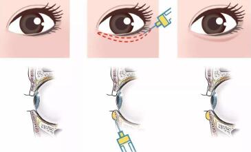 填充臥蠶的方法