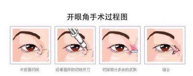開眼角手術(shù)能給你帶來哪些果?不僅僅是放大雙眼