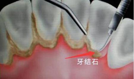 牙結(jié)石有什么危害?