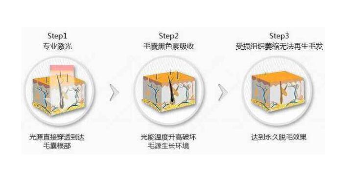 激光脫毛的副作用